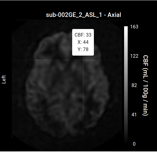 MRI View Hover Example